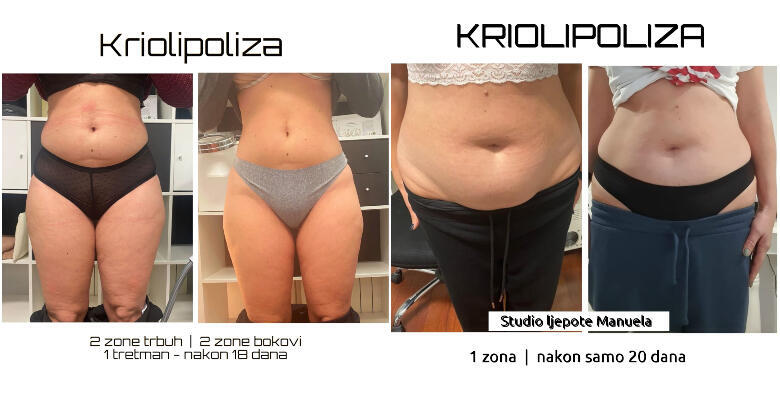 SVJETSKI HIT TRETMAN! Najbolji tretman zamrzavanja masnih stanica CryocoolSculpting 360 ili 4D kojeg koriste svjetski poznate osobe u Studiju ljepote Manuela