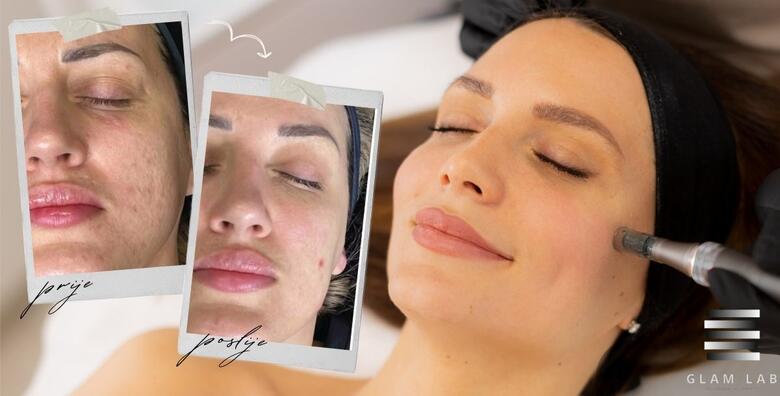 Edukacija microneedling - upoznajte se sa tehnikom regeneracije