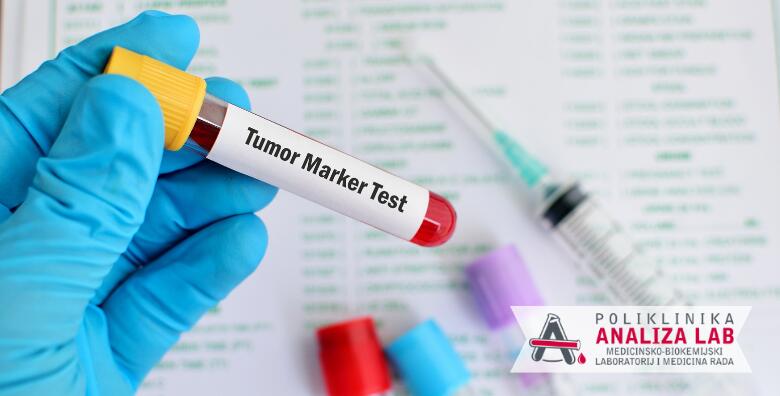Tumorski marker za žene ili muškarce - otkrijte tumor na vrijeme<br> u Poliklinici Analiza Lab