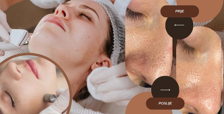 Ultrazvučno čišćenje lica špatulom uz njegu lica pilingom