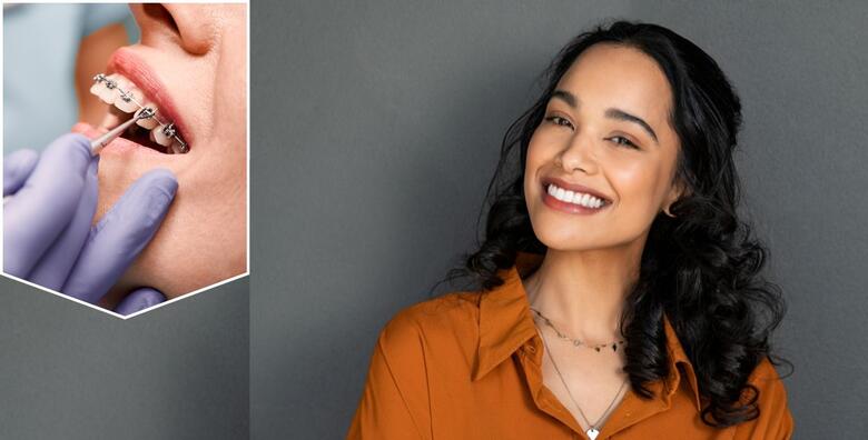 Fiksni aparatić za jednu čeljust uz uključene sve preglede i kontrole u <br>Specijalističkoj ordinaciji dentalne medicine za ortodonciju Dinko Čotić