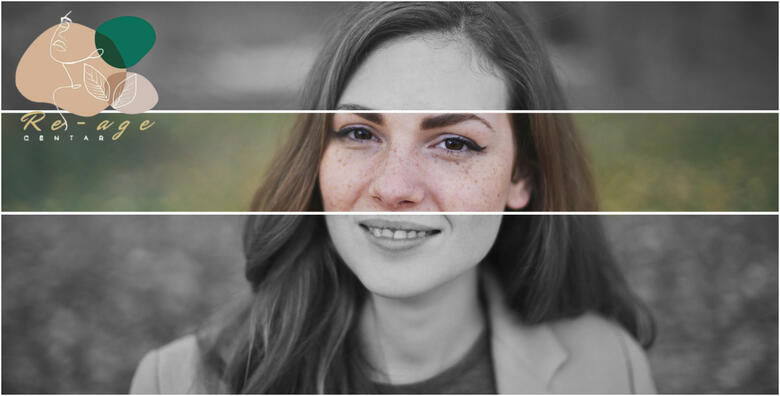 Želite se rješiti tamnih mrlja na svom licu ili rukama ili dekolteu? To više nije<br> problem uz IPL tretman za uklanjanje HIPERPIGMENTACIJE u Re-age Centru