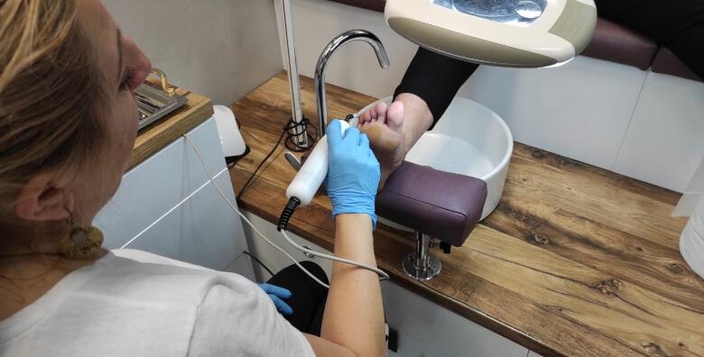 Vratite glatku kožu bez operacija - uklanjanje bradavice s ruke ili noge ozonom uz tretman biolaserom u Studiju ljepote Manuela