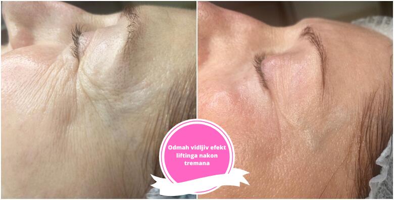 KOLAGEN NITI - potpuno prirodna i neinvazivna metoda smanjivanja bora <br>te liftinga lica s odmah vidljivim rezultatima u Studiju ljepote Manuela