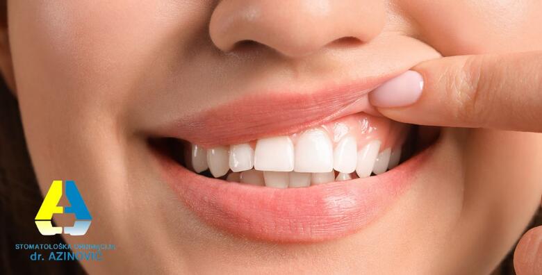 IZBJELJIVANJE ZUBI - laser ili Opalescence boost! Zablistaj ovu jesen uz čak nekoliko nijansi bjelije zube u Stomatološkoj ordinaciji Ivan Azinović