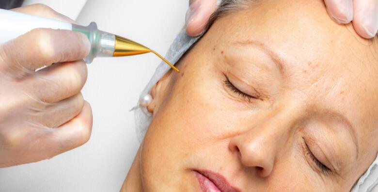 Uklanjanje bradavice