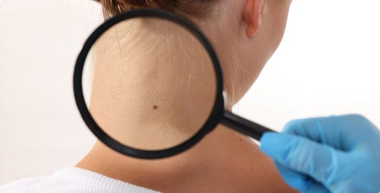 MADEŽI I BRADAVICE - otkrijte moguće zloćudne promjene i uklonite neželjene izrasline uz dermatoskopski pregled i lokalnu anesteziju u Poliklinici Superiora